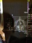 Светлые пятна на МРТ позвоночника фото 5