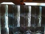 Светлые пятна на МРТ позвоночника фото 3