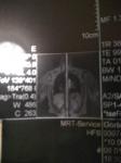 Светлые пятна на МРТ позвоночника фото 2