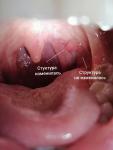 Остаток удалённой миндалины изменил структуру фото 1
