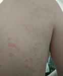 Аллергия и сильный зуд кожи фото 2