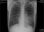 Воспаление лёгких, что с низу лёгких? фото 2