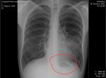Воспаление лёгких, что с низу лёгких? фото 3