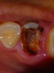 После удаления зуба в лунке белый кусочек фото 1
