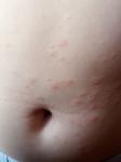 Сыпь на животе на лице у ребенка фото 2
