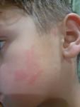 Пузыри на губах и красные пятна у ребенка фото 2
