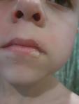 Пузыри на губах и красные пятна у ребенка фото 5
