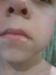 Пузыри на губах и красные пятна у ребенка фото 3