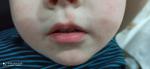 Красные пятна с шелушением, заходящего на губуна коже лица ребенка фото 1