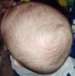Кривая голова с рождения фото 5