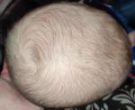 Кривая голова с рождения фото 3