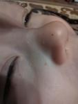 Сыпь на лице у ребенка молюск или просянка фото 1