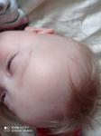 Бесцветная сыпь у ребенка 9 месяцев фото 3