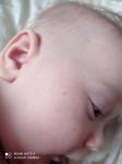 Бесцветная сыпь у ребенка 9 месяцев фото 2
