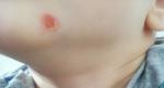 Единичные волдыри на теле и лице у ребенка, образующие раны фото 2