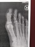 Косой перелом второго пальца на ноге со смещением фото 2