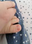 Что у ребёнка с ногтем? фото 2