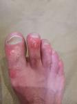 Вздутые покраснения на пальцах ног фото 1