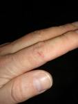 Проблема с кожей на пальцах рук фото 3