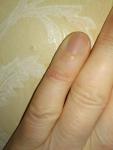 Проблема с кожей на пальцах рук фото 2