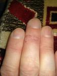 Проблема с кожей на пальцах рук фото 1