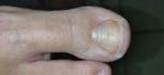 Полоска и пятно на ногте большого пальца фото 1