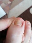 Потемнение под ногтем пальца ноги фото 1