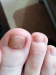 Потемнение под ногтем пальца ноги фото 2