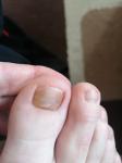 Потемнение под ногтем пальца ноги фото 3