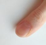 Изменение ногтя на большом пальце с одной стороны фото 1