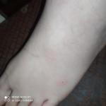 Шишки на ногах болезненные фото 3