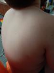 Сыпь на спине у ребенка фото 2
