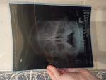 Рентген пазух носа при болях в переносице и насморке фото 1