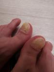 Жуткий грибок ногтей фото 3