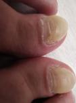 Жуткий грибок ногтей фото 1