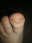 Боль в ногте ноги при надавливании фото 2