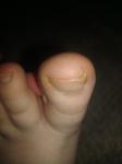 Боль в ногте ноги при надавливании фото 3
