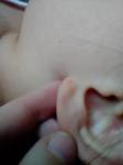 Точечные красные пятнышки на мочке уха фото 1