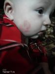 Высыпания на щеке у ребёнка 6 месяцев фото 5