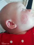 Высыпания на щеке у ребёнка 6 месяцев фото 3