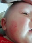 Высыпания на щеке у ребёнка 6 месяцев фото 2