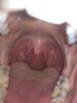 Лимфоузлы, общее состояние горла фото 1