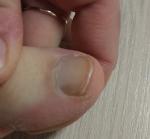 Пятно на ногтевой пластине ноги фото 1