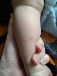 Страшные высыпания на ногах ребенку 1.5 фото 1