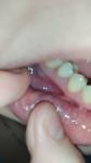 Ноет леченый зуб и болит десна при ОРВИ фото 1