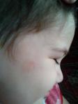 Пятно на лице у ребенка фото 1