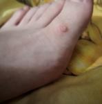 Нарост на пальце ноги фото 1