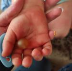 Сыпь у ребенка на руках и теле фото 1