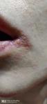 Герпес или другое заболевание кожи вокруг нижней губы фото 1