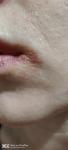 Герпес или другое заболевание кожи вокруг нижней губы фото 2